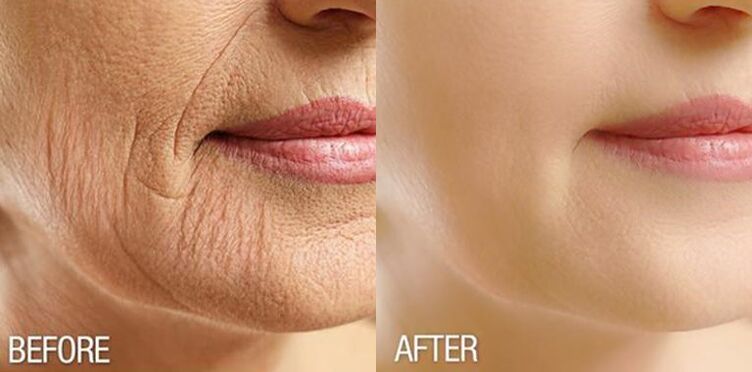 Facial skin before and after the Yenki Derm course, effect of the serum