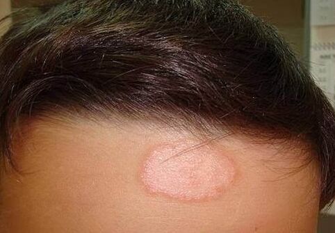 Psoriatic point