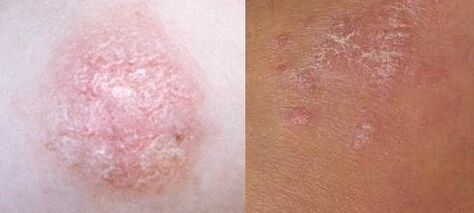 Psoriasis at the early stage